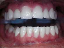 Hollywood smile in one week - Implantcenter Budapest