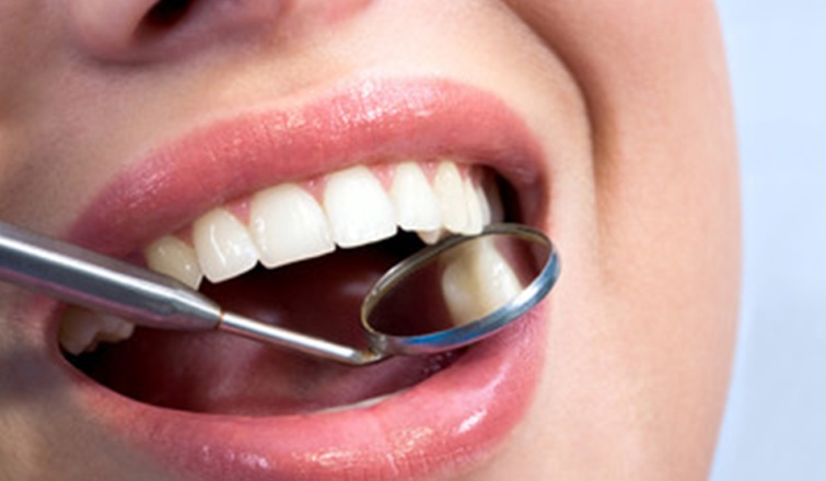 fillings