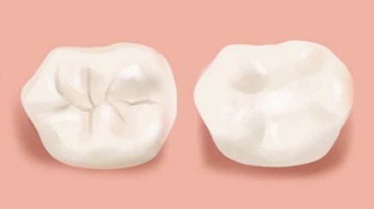 fillings2