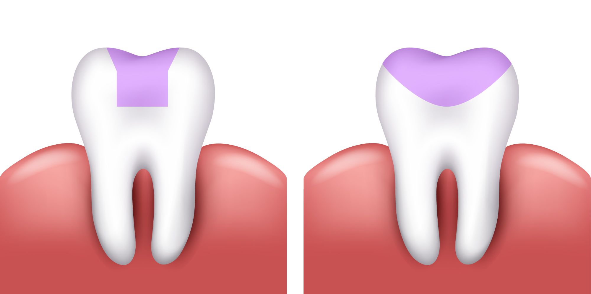 fillings3