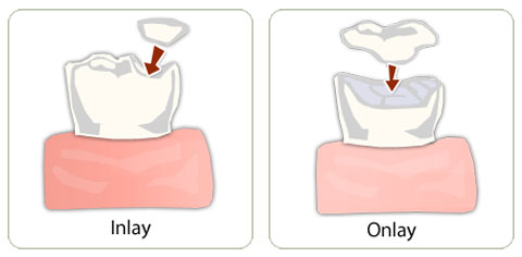 inlay-onlay-dental-fillings-1