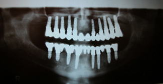X-ray of upper and lower implants supported denture