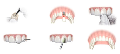 Dental implantations - Good to know - dentist abroad, Hungary, Budapest