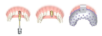 Attaching dental implant's head to the implant - Dental implants abroad