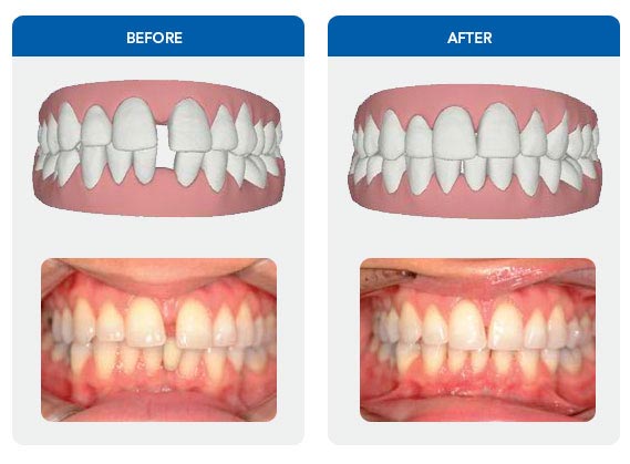 ba-invisalign-1