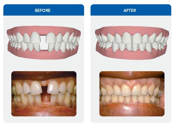 ba-invisalign-3