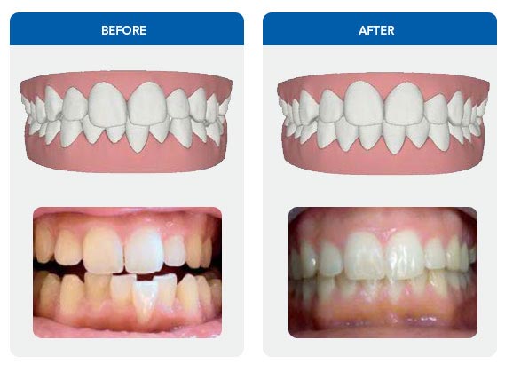 ba-invisalign-4